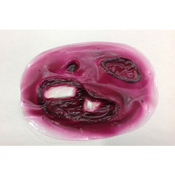 Compound Fracture Tibia Bleeding Moulage